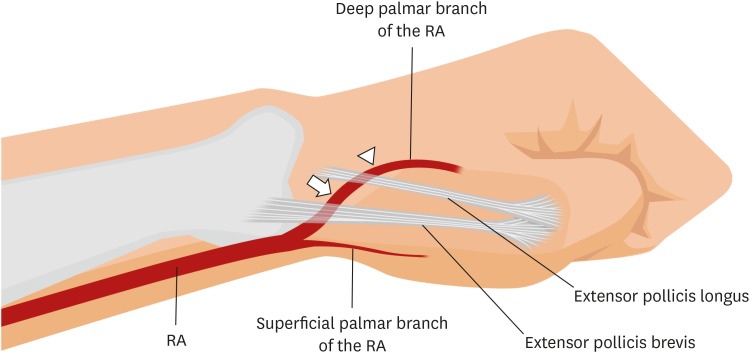About Radial Access – Compression Tourniquet